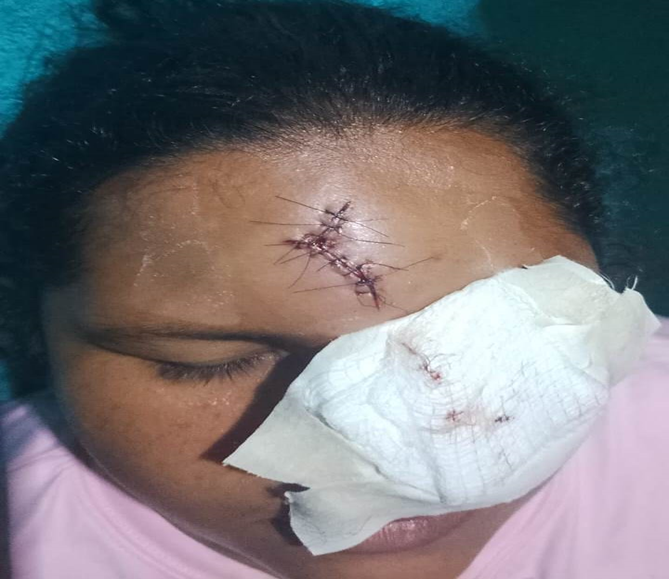 Indica «lesiones leves» Mujer alerta que hombre que le desfiguró el rostro puede salir libre por «extraño» informe forense